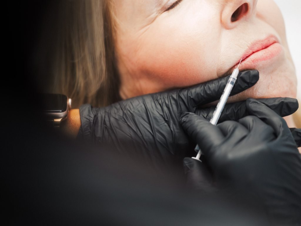 Dr. Lauren injecting filler in a patient's lip area.