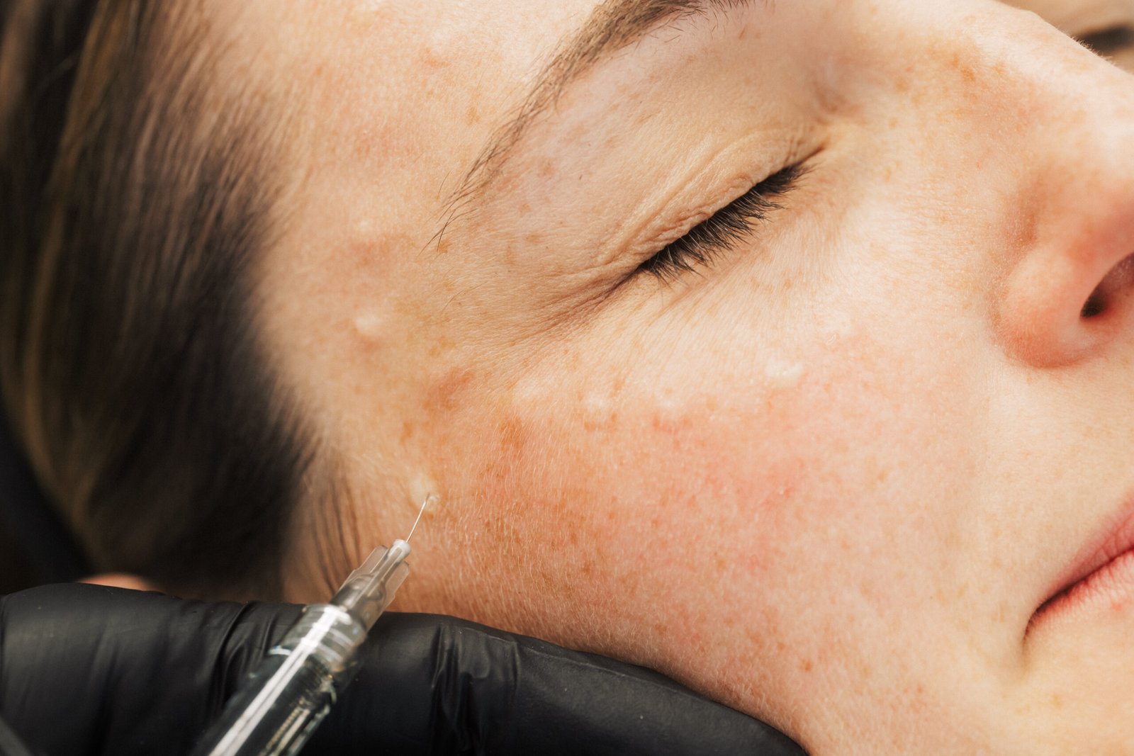 Dr. Lauren injecting polynucleotides in a patient's upper-cheek area.
