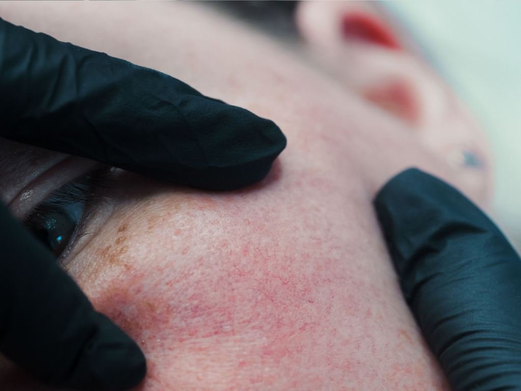 Close-up of a patient's cheek with rosacea.