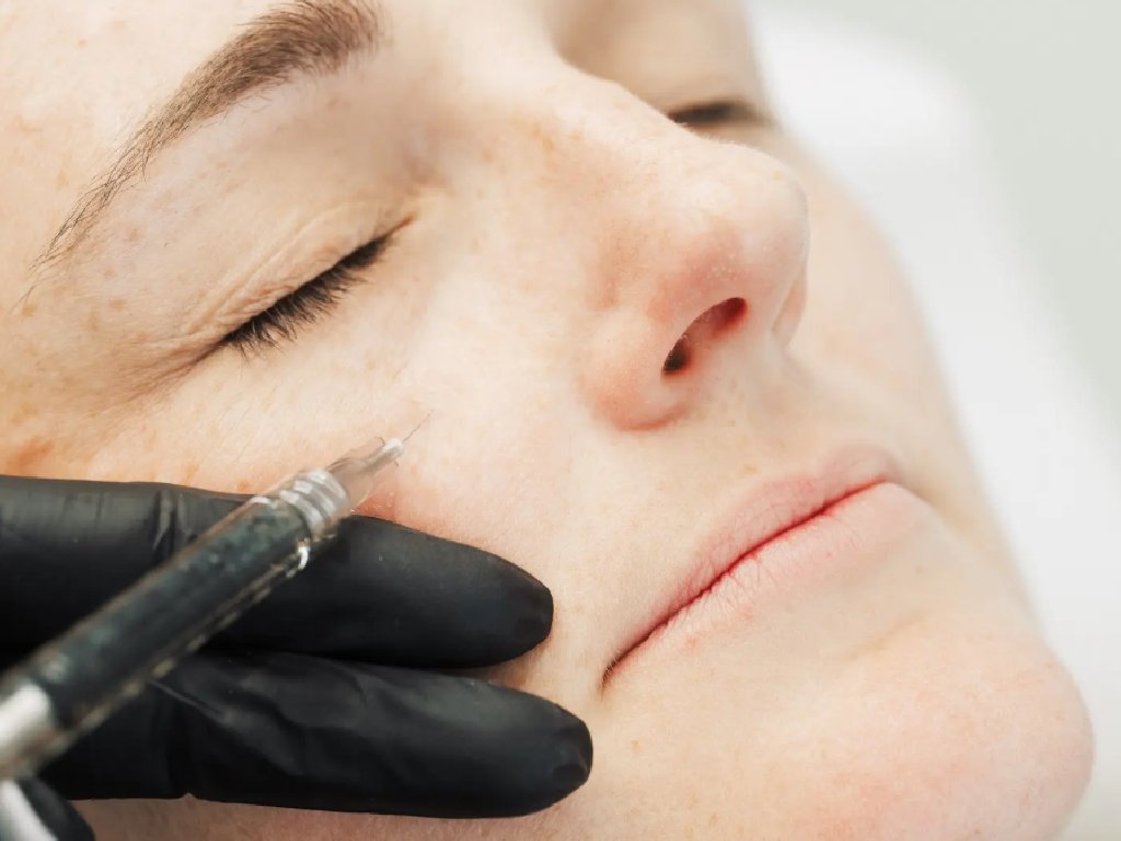 Dr. Lauren injecting Profhilo in a patient's cheek area.