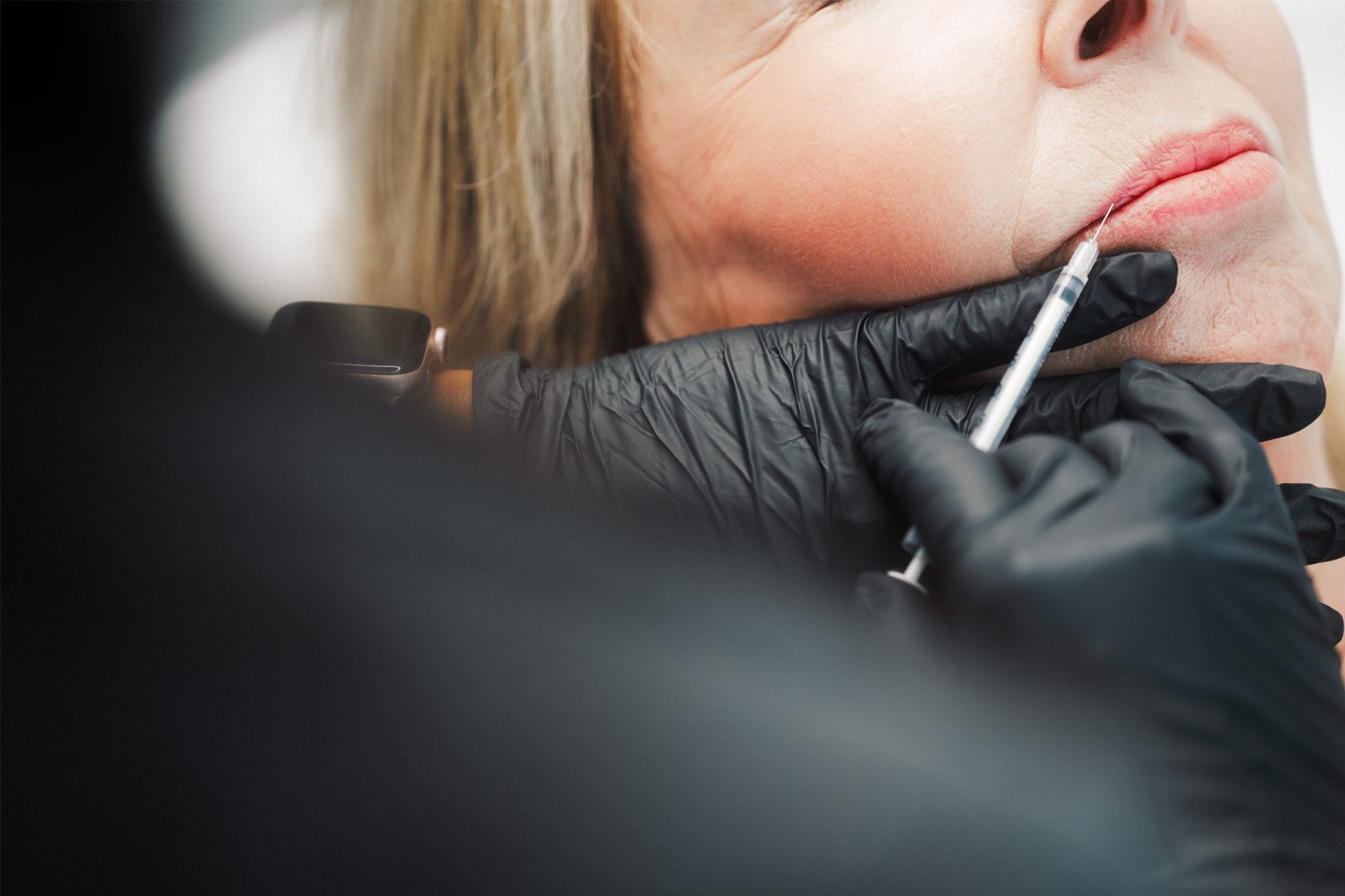Dr Lauren injecting lip fillers into a patient's lips.