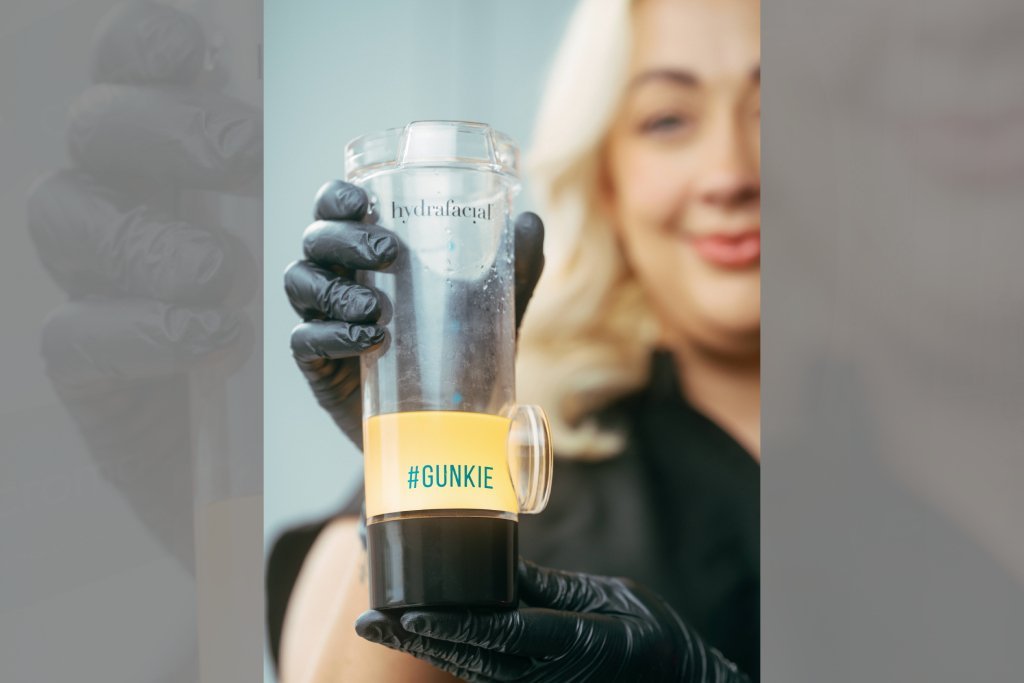 Dr Lauren's skin therapist with the gunkie excess oil and dirt extracted from a patient's face during Hydrafacial.